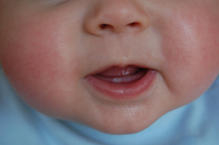 مشكلات التسنين